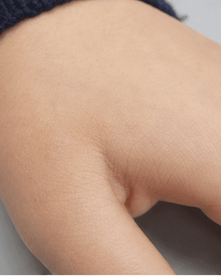 Children's Wart Treatment: after