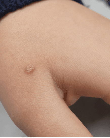 Children's Wart Treatment: before