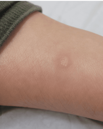Children's Wart Treatment: after