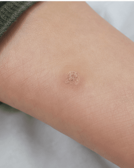 Children's Wart Treatment: before