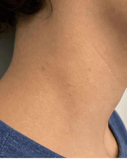 Molluscum Contagiosum: after