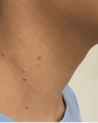 Molluscum Contagiosum: before