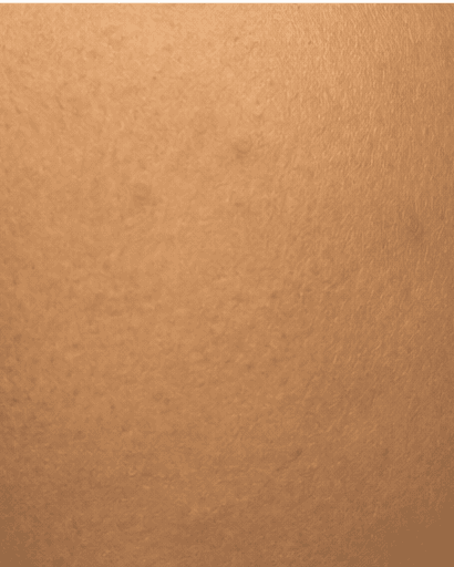 Molluscum Contagiosum: after