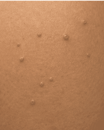Molluscum Contagiosum: before