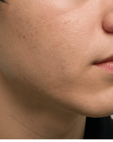 Teenage Acne Programme: after