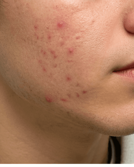 Teenage Acne Programme: before