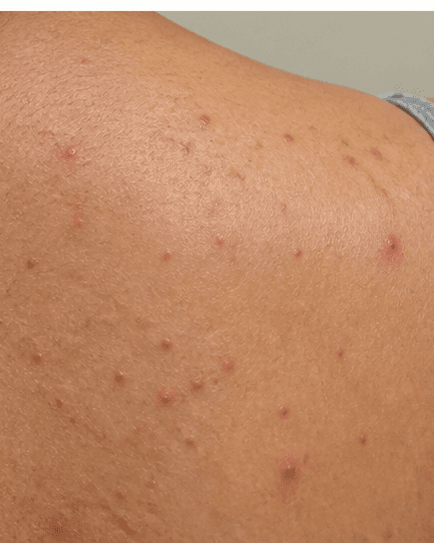 Teenage Acne Programme: before