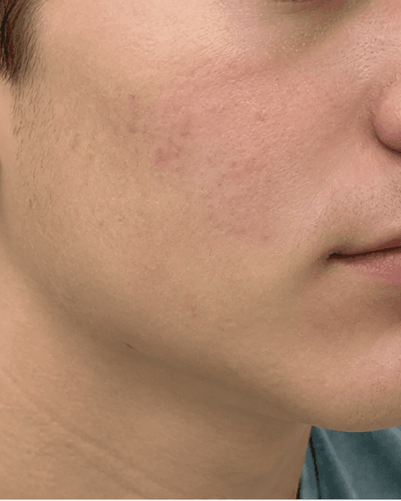 Teen Skin Consultation: after