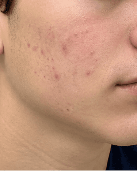 Teen Skin Consultation: before