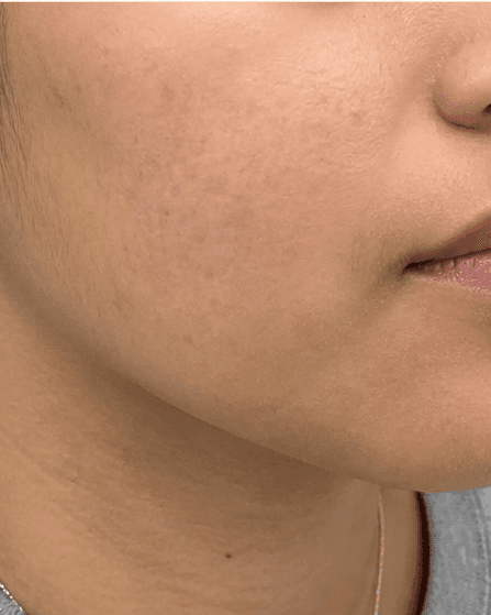 Teen Skin Consultation: after
