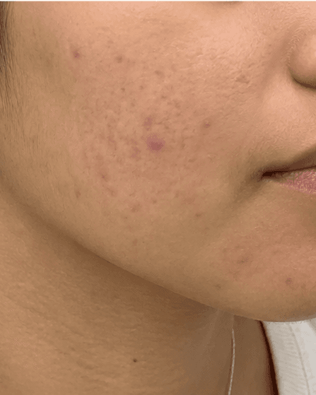 Teen Skin Consultation: before