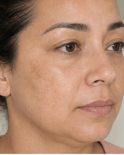 Depigmenting Mask Peel: after