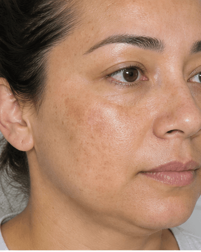Depigmenting Mask Peel: before