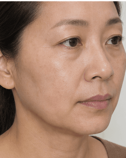 Depigmenting Mask Peel: after