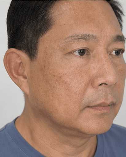 Glutathione Infusion: before