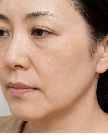 Hori's Nevus Treatment: after