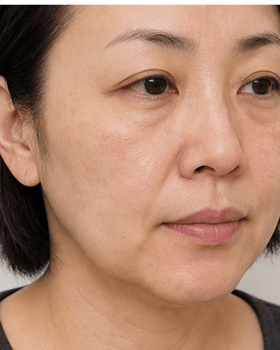 Hori's Nevus Treatment: after