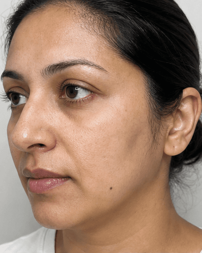 Melasma Programme: after