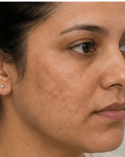 Melasma Protocol: before