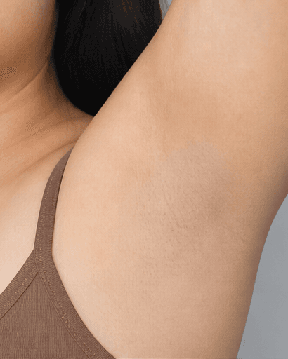 Underarm Brightening: after