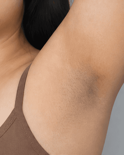 Underarm Brightening: before