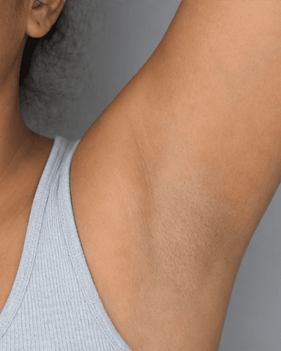 Underarm Brightening: after