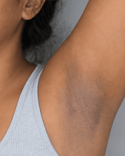 Underarm Brightening: before
