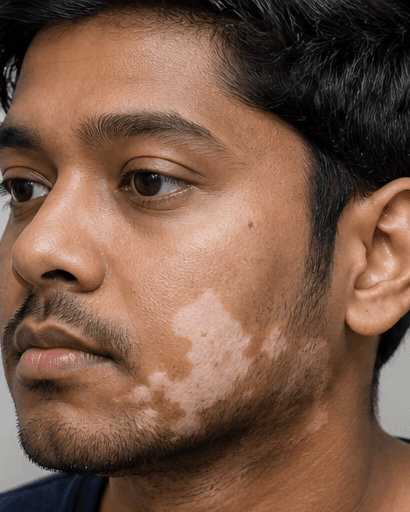 Vitiligo Management: before