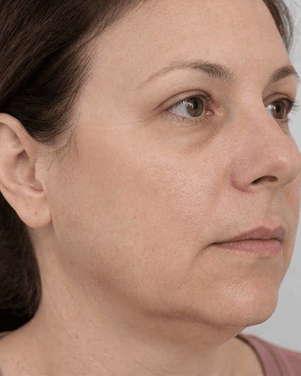 Post-Procedure Drainage: after