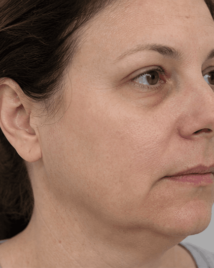 Post-Procedure Drainage: before