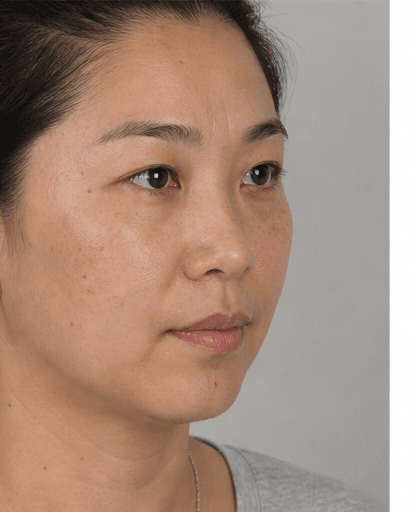 Post-Laser Recovery: after