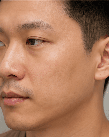 Collagen Induction Therapy: after