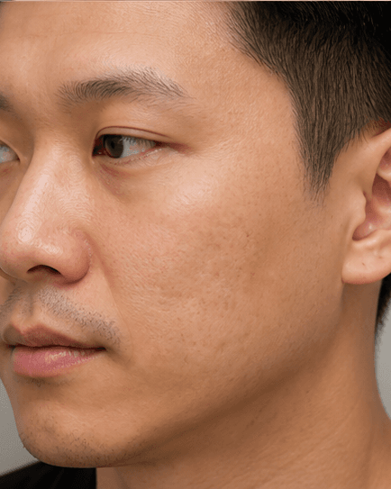 Collagen Induction Therapy: before