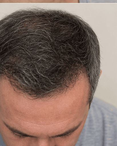 PRP Facial Therapy: after