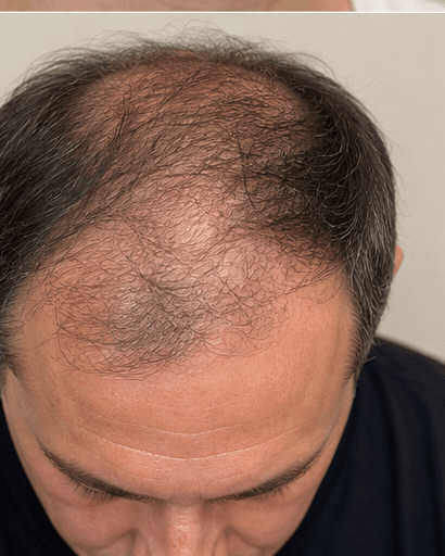 PRP Facial Therapy: before