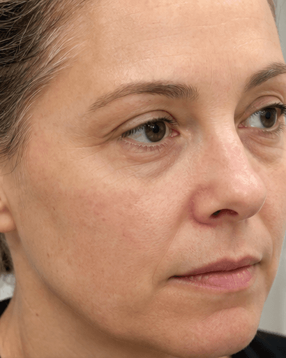 Skin Booster Course: after
