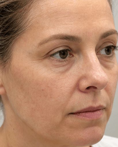Skin Booster Course: before