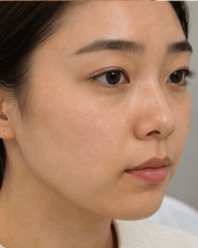 Skin Booster Course: before