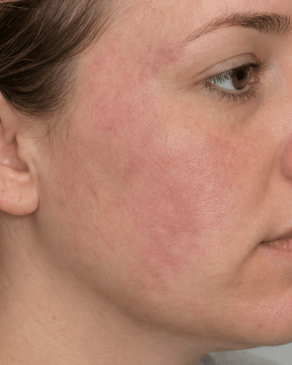 Birthmark Assessment: after
