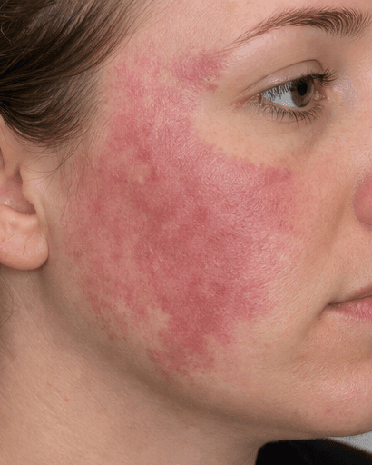 Birthmark Assessment: before