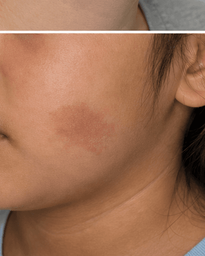 Birthmark Assessment: after