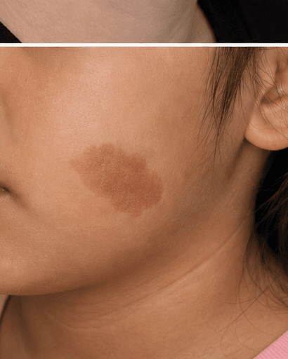 Birthmark Assessment: before