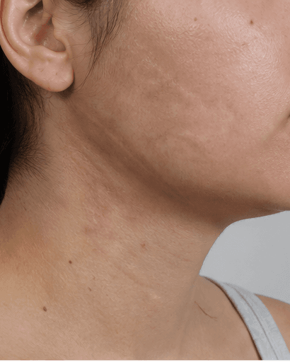 Burn Scar Treatment: after