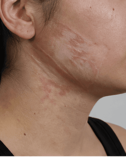 Burn Scar Treatment: before