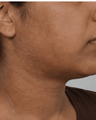 Burn Scar Treatment: after