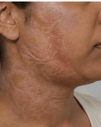 Burn Scar Treatment: before