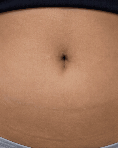 C-Section Scar Treatment: after