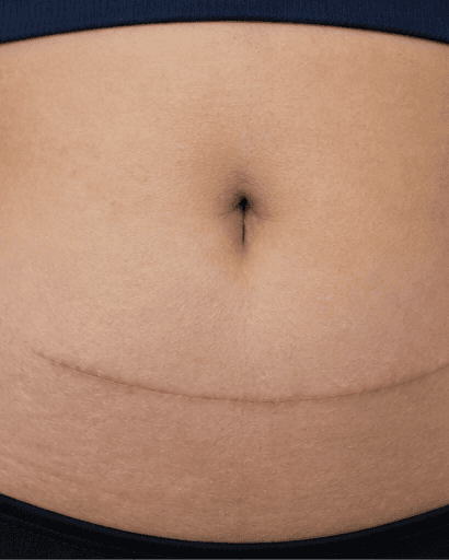 C-Section Scar Treatment: before