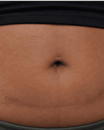 C-Section Scar Treatment: after
