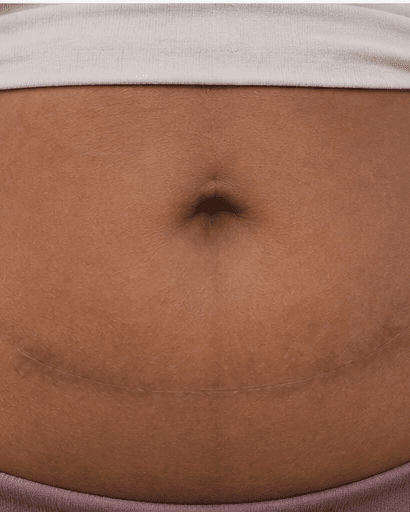 C-Section Scar Treatment: before